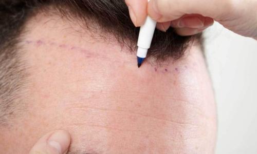 FUE Hair Transplant
