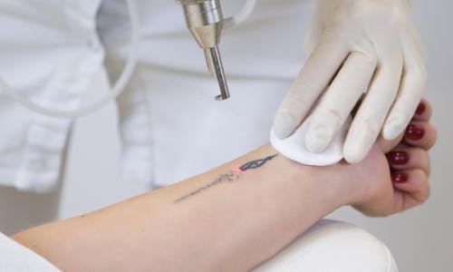 Laser for Tattoo & Hair Removal