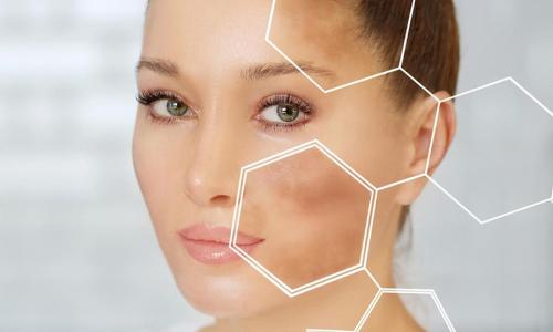 Melasma treatment