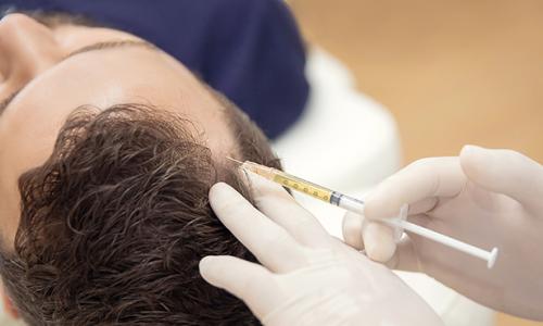 Mesotherapy for Hair Growth