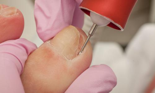 Nail Surgery